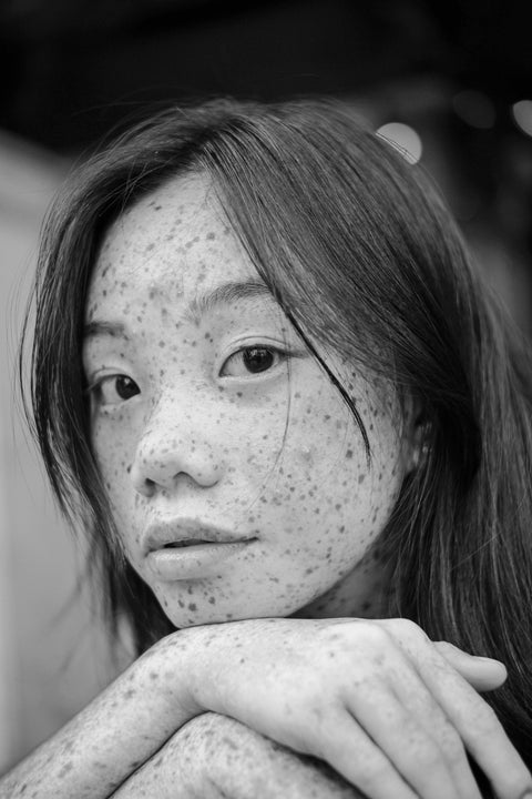 Acne Care